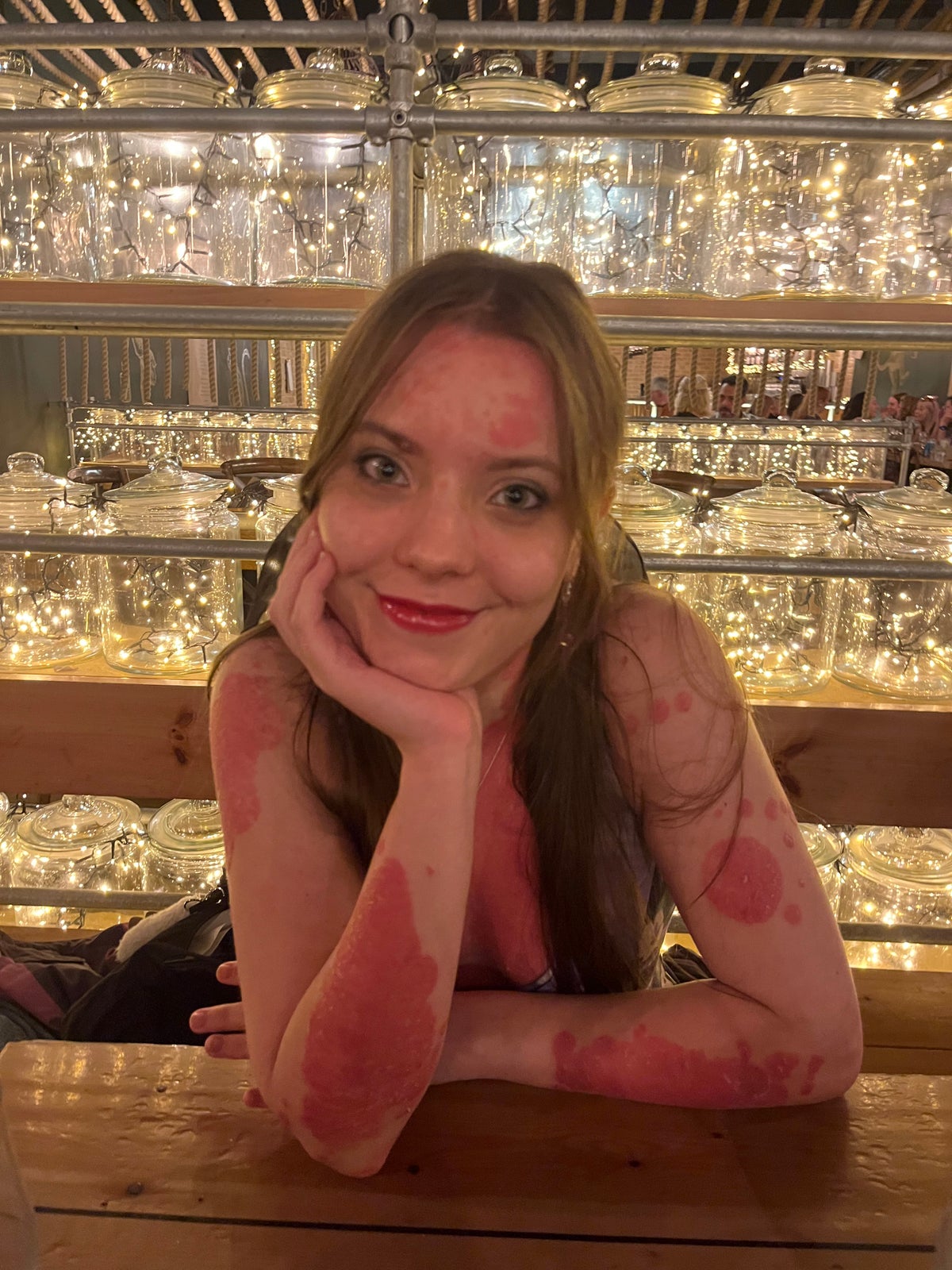 The influencers living with Psoriasis – and what they want you to know about the condition post thumbnail image